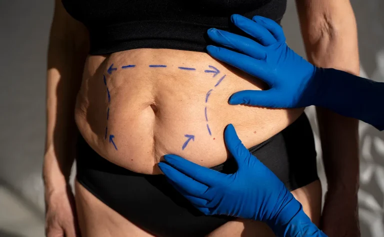 Liposuction in Dubai